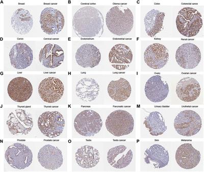 Multi-omics analysis of TLCD1 as a promising biomarker in pan-cancer